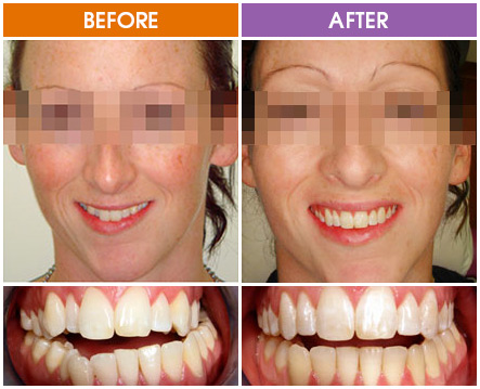 Braces Before And After | Brisbane | Orthosmile